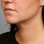 Neck Liposuction / Chin Liposuction Before & After Patient #1839