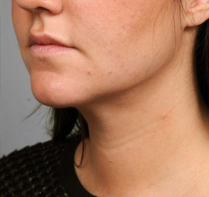 Neck Liposuction / Chin Liposuction Before & After Patient #1839