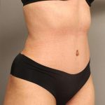 Tummy Tuck Before & After Patient #238