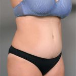 Tummy Tuck Before & After Patient #386