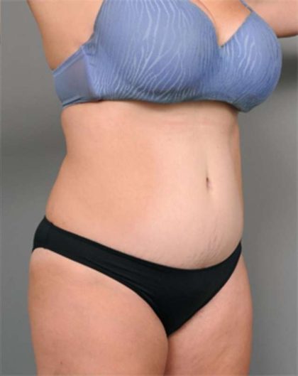 Tummy Tuck Before & After Patient #386