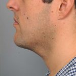Neck Liposuction / Chin Liposuction Before & After Patient #1846