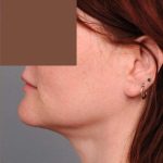 Neck Liposuction / Chin Liposuction Before & After Patient #1854