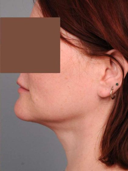 Neck Liposuction / Chin Liposuction Before & After Patient #1854