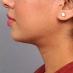 Neck Liposuction / Chin Liposuction Before & After Patient #1859