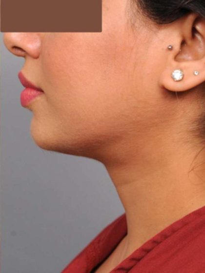 Neck Liposuction / Chin Liposuction Before & After Patient #1859
