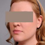 Neck Liposuction / Chin Liposuction Before & After Patient #1864
