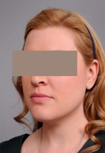 Neck Liposuction / Chin Liposuction Before & After Patient #1864