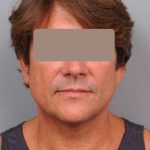 Neck Liposuction / Chin Liposuction Before & After Patient #1877