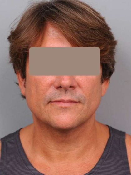 Neck Liposuction / Chin Liposuction Before & After Patient #1877