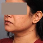 Neck Liposuction / Chin Liposuction Before & After Patient #1893