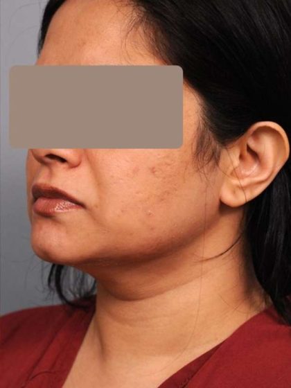 Neck Liposuction / Chin Liposuction Before & After Patient #1893