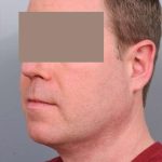 Neck Liposuction / Chin Liposuction Before & After Patient #1900
