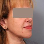 Neck Liposuction / Chin Liposuction Before & After Patient #1905