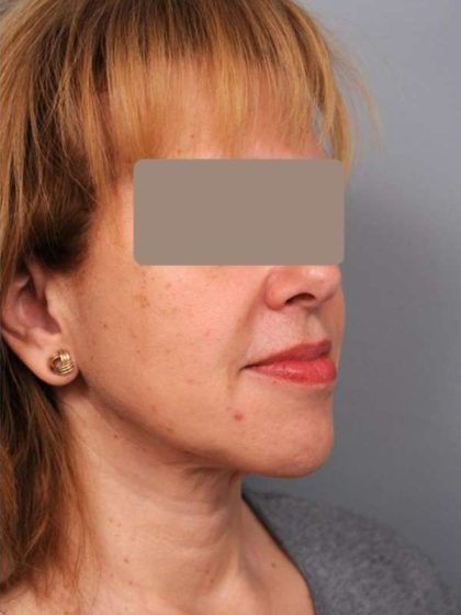 Neck Liposuction / Chin Liposuction Before & After Patient #1905