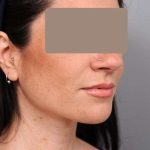 Neck Liposuction / Chin Liposuction Before & After Patient #1913