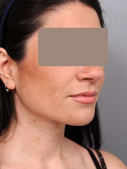 Neck Liposuction / Chin Liposuction Before & After Patient #1913