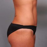 Tummy Tuck Before & After Patient #395