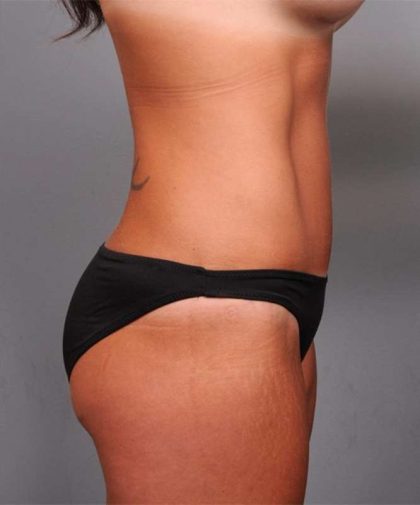 Tummy Tuck Before & After Patient #395