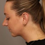 Neck Liposuction / Chin Liposuction Before & After Patient #1923