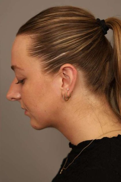 Neck Liposuction / Chin Liposuction Before & After Patient #1923