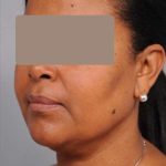 Neck Liposuction / Chin Liposuction Before & After Patient #1930