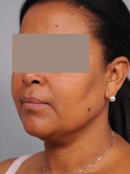 Neck Liposuction / Chin Liposuction Before & After Patient #1930
