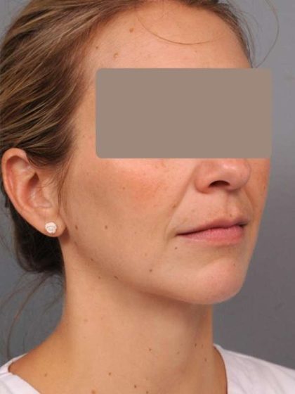 Neck Liposuction / Chin Liposuction Before & After Patient #1937