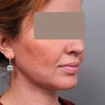 Neck Liposuction / Chin Liposuction Before & After Patient #1946
