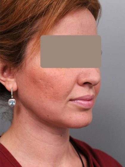 Neck Liposuction / Chin Liposuction Before & After Patient #1946