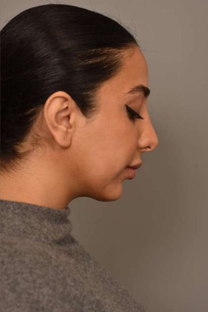 Neck Liposuction / Chin Liposuction Before & After Patient #1953