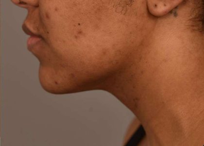 Neck Liposuction / Chin Liposuction Before & After Patient #1978