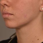 Neck Liposuction / Chin Liposuction Before & After Patient #1983