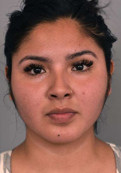 Neck Liposuction / Chin Liposuction Before & After Patient #1990