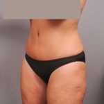 Tummy Tuck Before & After Patient #402