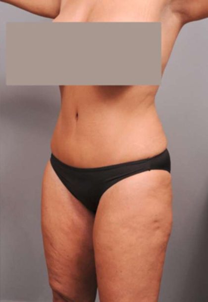 Tummy Tuck Before & After Patient #402