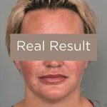 Neck Liposuction / Chin Liposuction Before & After Patient #2002