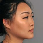Neck Liposuction / Chin Liposuction Before & After Patient #2011