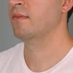Neck Liposuction / Chin Liposuction Before & After Patient #2027