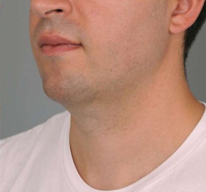 Neck Liposuction / Chin Liposuction Before & After Patient #2027