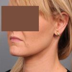 Neck Liposuction / Chin Liposuction Before & After Patient #2034
