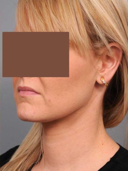 Neck Liposuction / Chin Liposuction Before & After Patient #2034