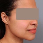 Neck Liposuction / Chin Liposuction Before & After Patient #2046