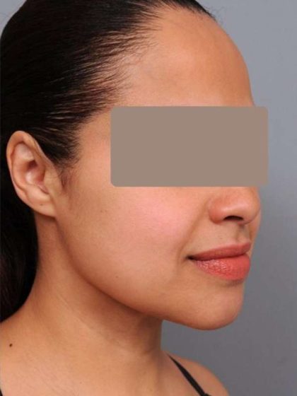Neck Liposuction / Chin Liposuction Before & After Patient #2046