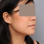 Neck Liposuction / Chin Liposuction Before & After Patient #2051