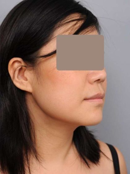 Neck Liposuction / Chin Liposuction Before & After Patient #2051