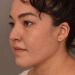 Buccal Fat Removal Before & After Patient #2071