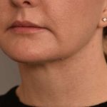 Buccal Fat Removal Before & After Patient #2080