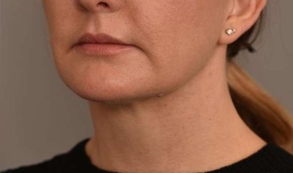 Buccal Fat Removal Before & After Patient #2080