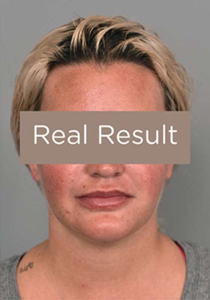 Buccal Fat Removal Before & After Patient #2108